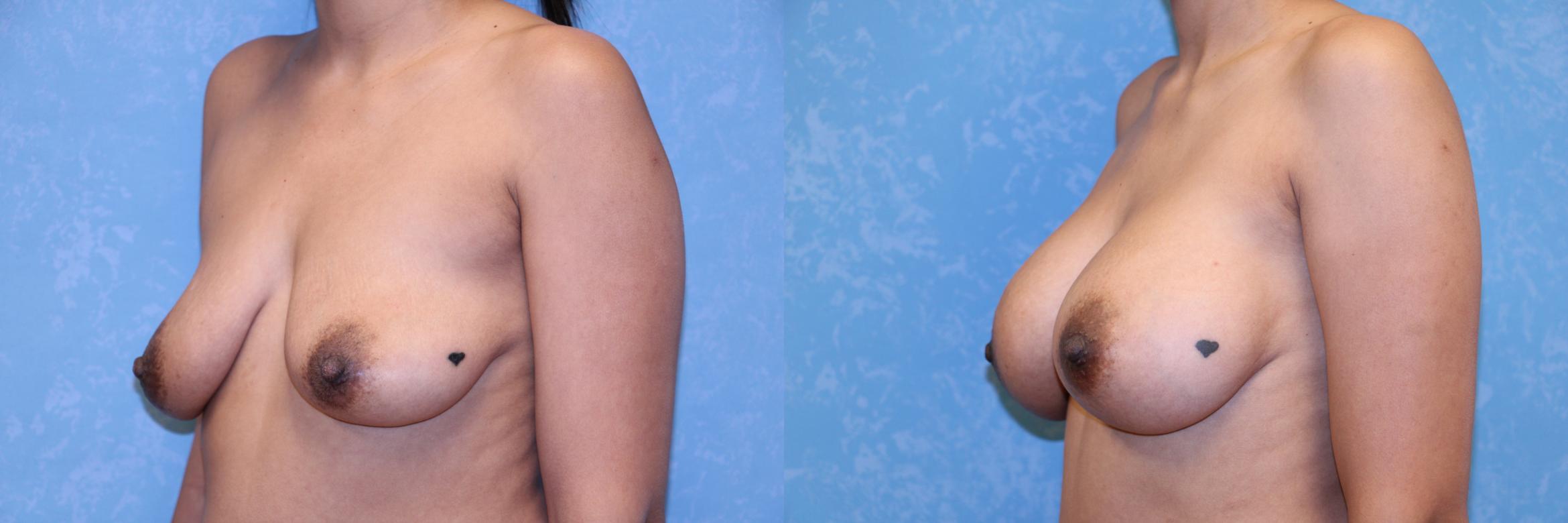 Before & After Breast Augmentation Case 3 Left Oblique View in Toledo, OH