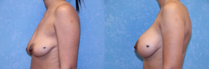 Before & After Breast Augmentation Case 3 Left Side View in Toledo, OH
