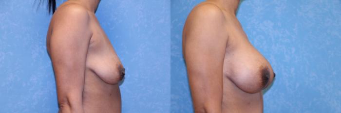 Before & After Breast Augmentation Case 3 Right Side View in Toledo, OH