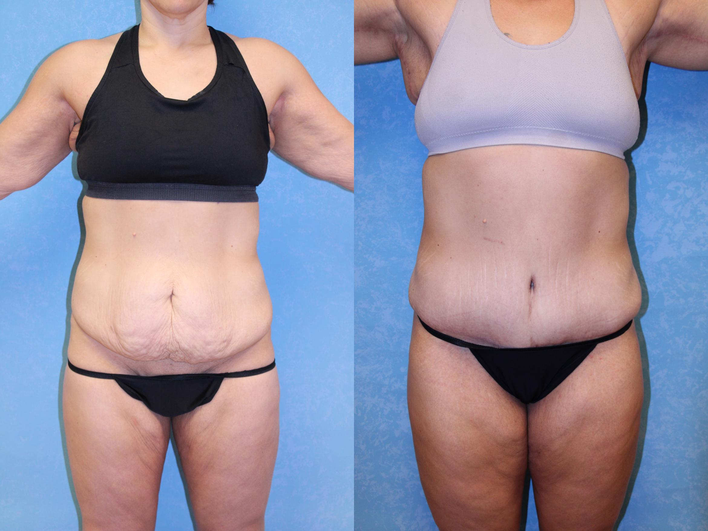 Before & After Post-Weight Loss Surgery Case 2 Front View in Toledo, OH