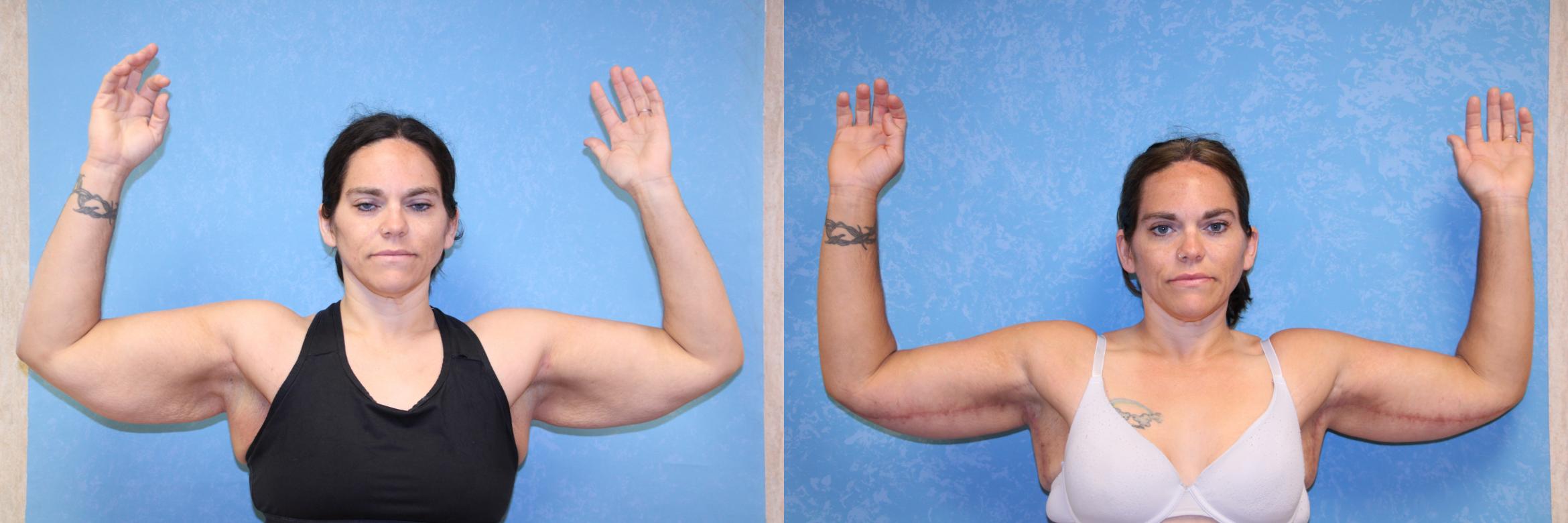 Before & After Post-Weight Loss Surgery Case 2 Front Upper Body View in Toledo, OH