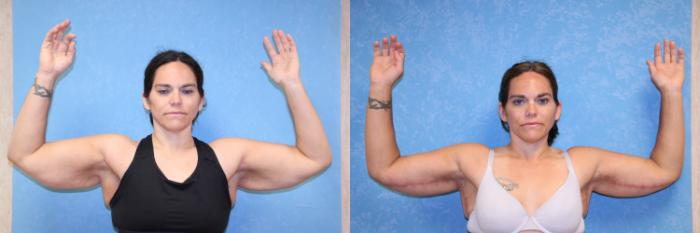 Before & After Post-Weight Loss Surgery Case 2 Front Upper Body View in Toledo, OH