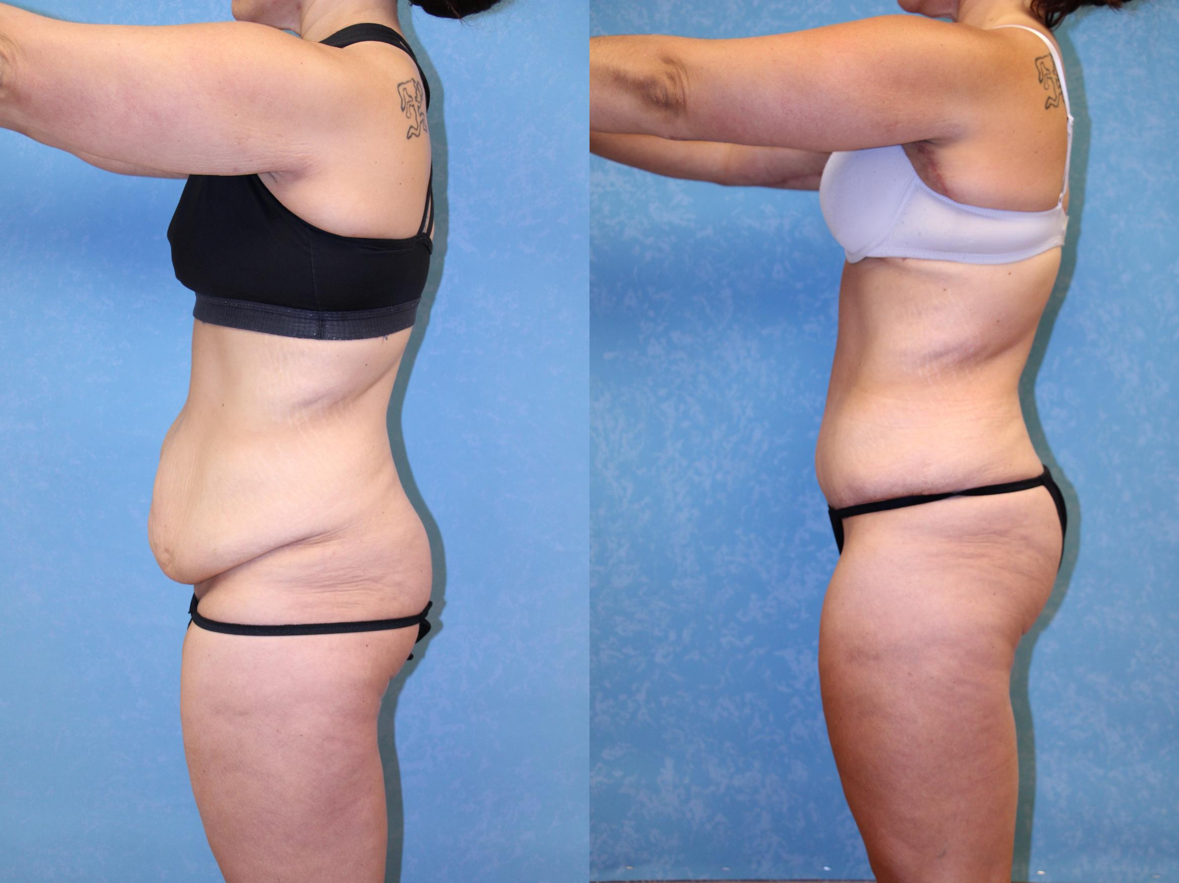 Before & After Post-Weight Loss Surgery Case 2 Left Side View in Toledo, OH