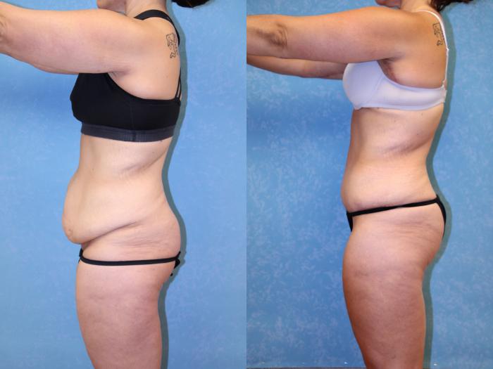 Before & After Post-Weight Loss Surgery Case 2 Left Side View in Toledo, OH