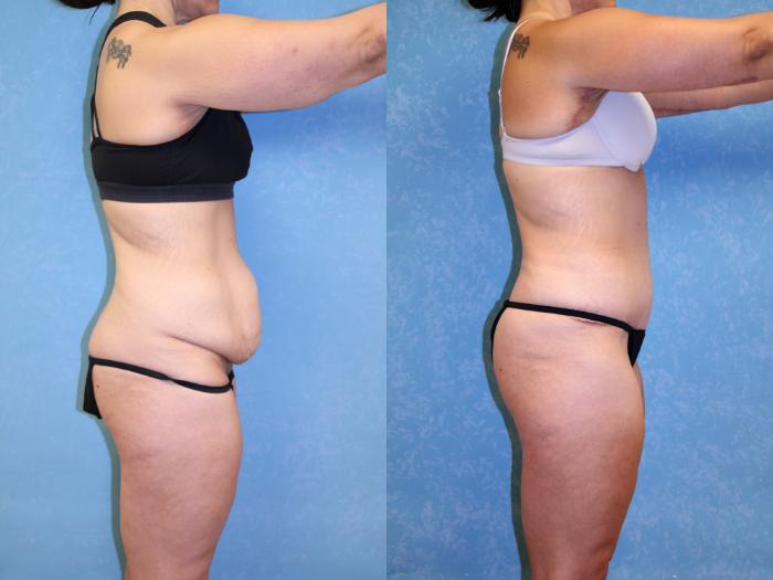 Before & After Post-Weight Loss Surgery Case 2 Right Side View in Toledo, OH